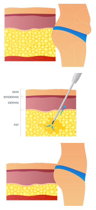 VASER Liposuction Image